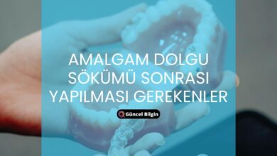 Photo of Amalgam Dolgu Sökümü Sonrası Yapılması Gerekenler