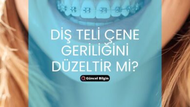 Photo of Diş Teli Çene Geriliğini Düzeltir Mi? Ortodonti Tedavisi Rehberi